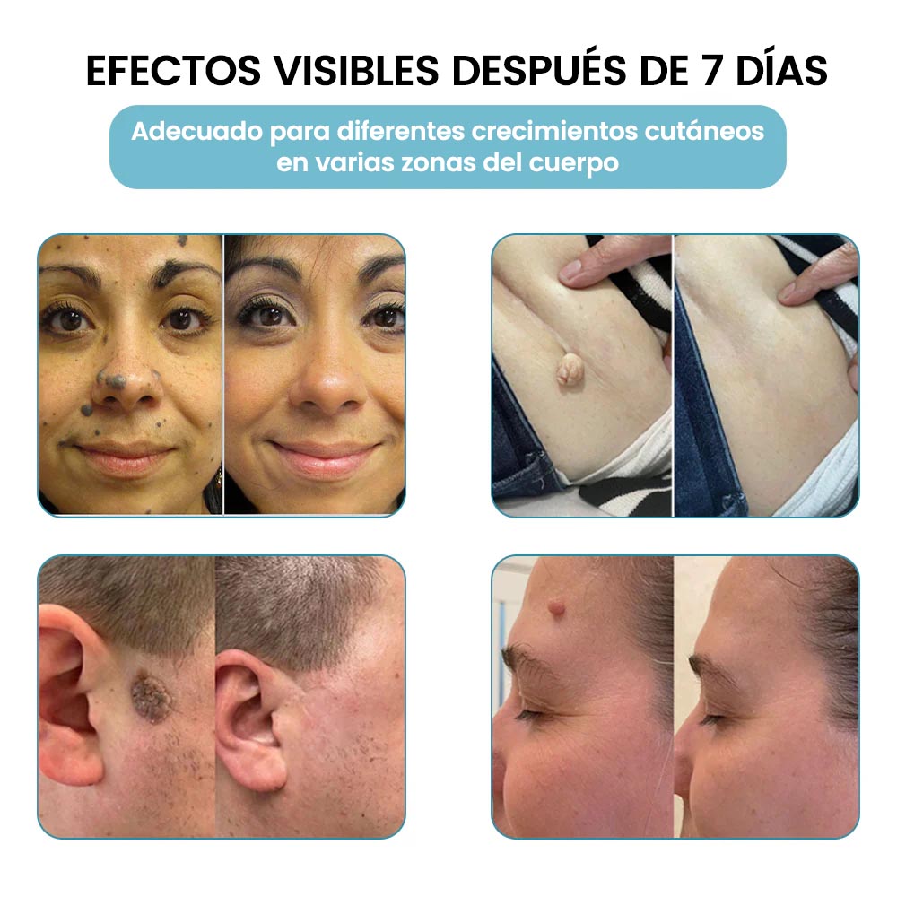 🏆Lápiz láser de grado médico Natravor™ 💕 (con tecnología láser de CO₂, elimina eficazmente lunares, verrugas, marcas en la piel, manchas de pigmentación y otras imperfecciones de la piel)