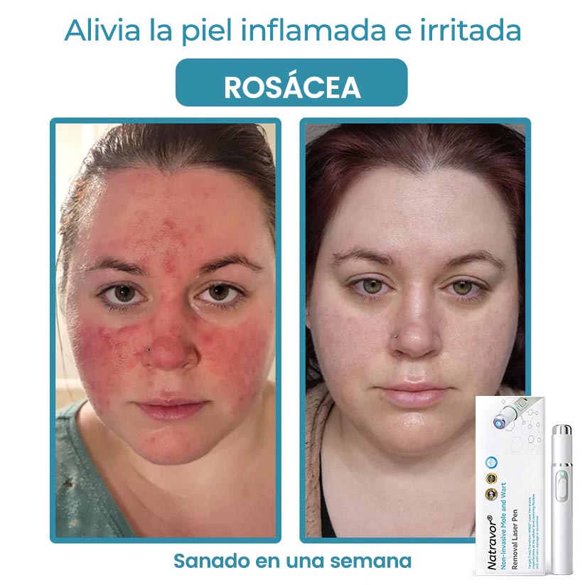 🏆Lápiz láser de grado médico Natravor™ 💕 (con tecnología láser de CO₂, elimina eficazmente lunares, verrugas, marcas en la piel, manchas de pigmentación y otras imperfecciones de la piel)