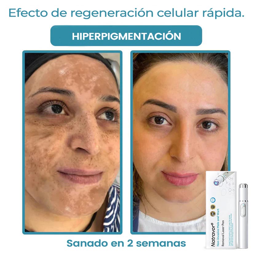 🏆Lápiz láser de grado médico Natravor™ 💕 (con tecnología láser de CO₂, elimina eficazmente lunares, verrugas, marcas en la piel, manchas de pigmentación y otras imperfecciones de la piel)
