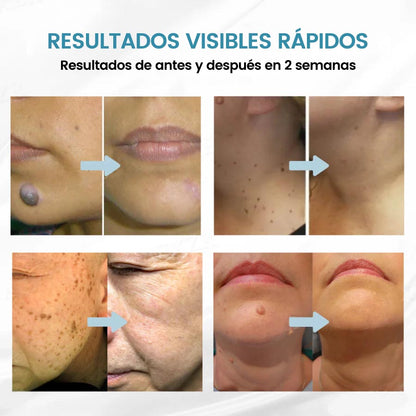 🏆Lápiz láser de grado médico Ｎatravor™ 💕 (con tecnología láser de CO₂, elimina eficazmente lunares, verrugas, marcas en la piel, manchas de pigmentación y otras imperfecciones de la piel)