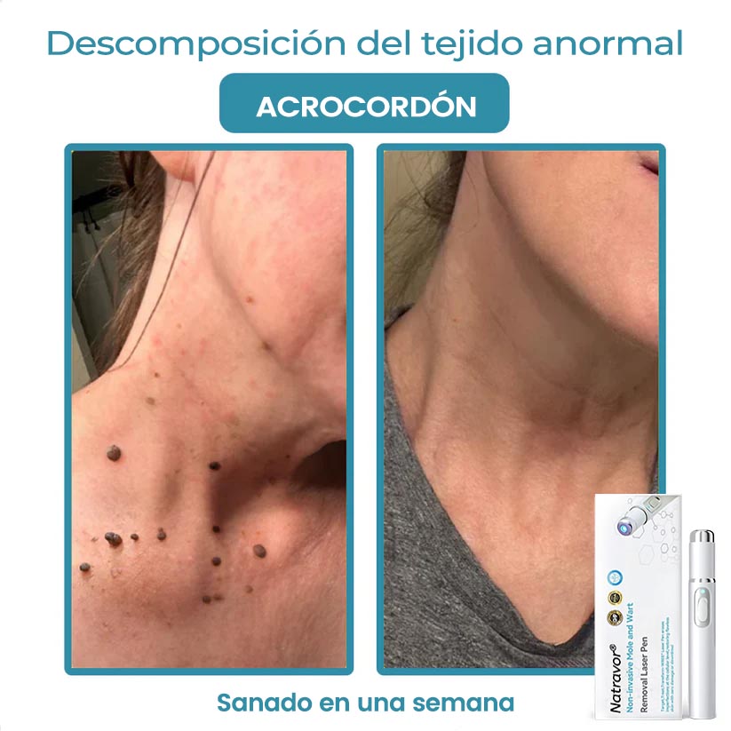 🏆Lápiz láser de grado médico Ｎatravor™ 💕 (con tecnología láser de CO₂, elimina eficazmente lunares, verrugas, marcas en la piel, manchas de pigmentación y otras imperfecciones de la piel)