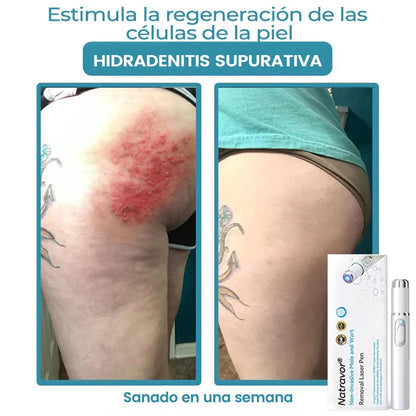 🏆Lápiz láser de grado médico Ｎatravor™ 💕 (con tecnología láser de CO₂, elimina eficazmente lunares, verrugas, marcas en la piel, manchas de pigmentación y otras imperfecciones de la piel)