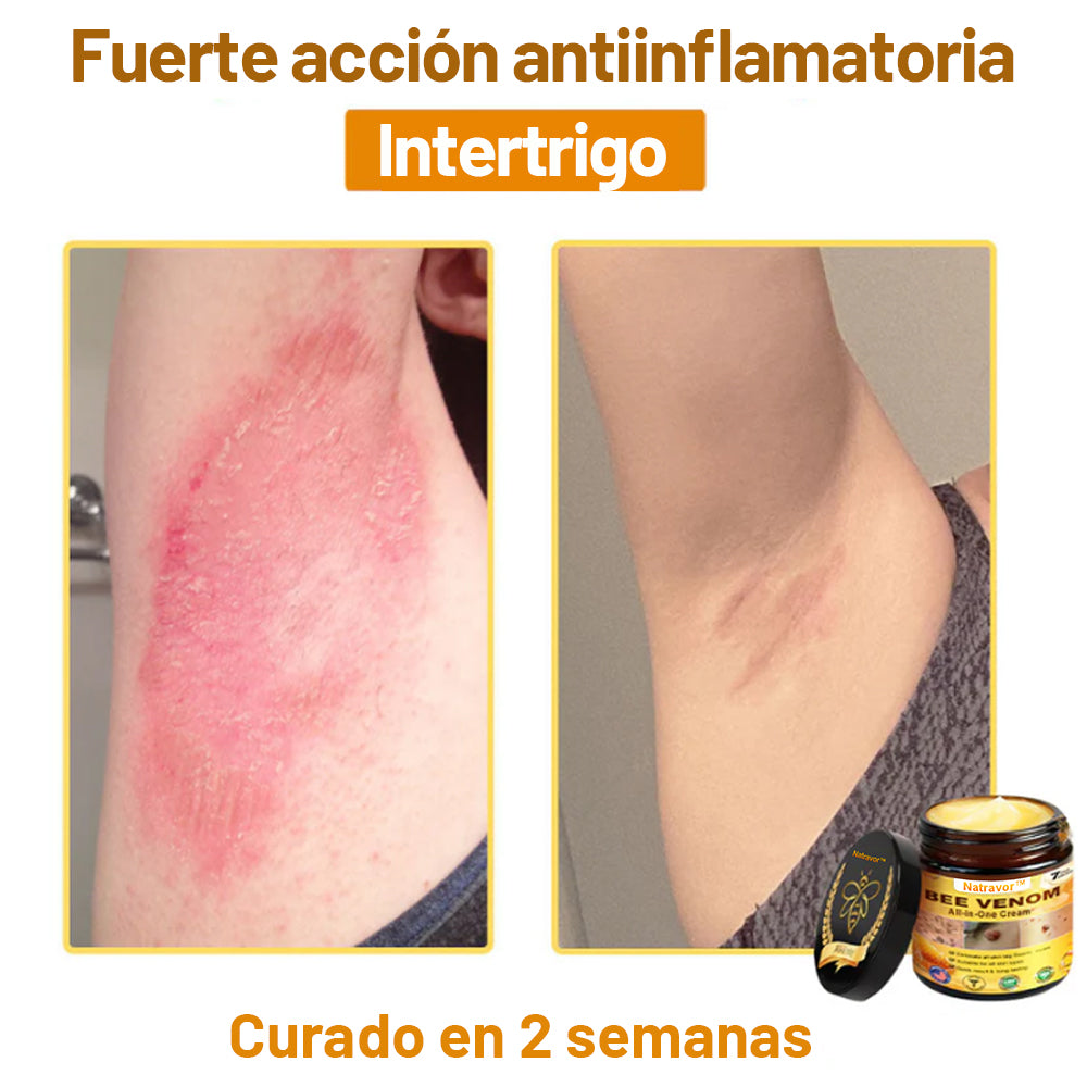 Natravor™ 🐝Crema todo en uno con veneno de abeja aprobada por dermatólogos en EE. UU.