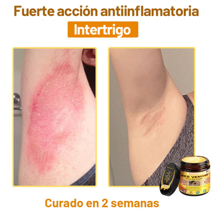 Natravor™ 🐝Crema todo en uno con veneno de abeja aprobada por dermatólogos en EE. UU.