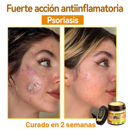 Natravor™ 🐝Crema todo en uno con veneno de abeja aprobada por dermatólogos en EE. UU.